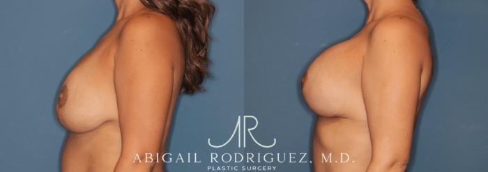 Before & After Breast Revision Case 346000 Left Side View in Houston, TX