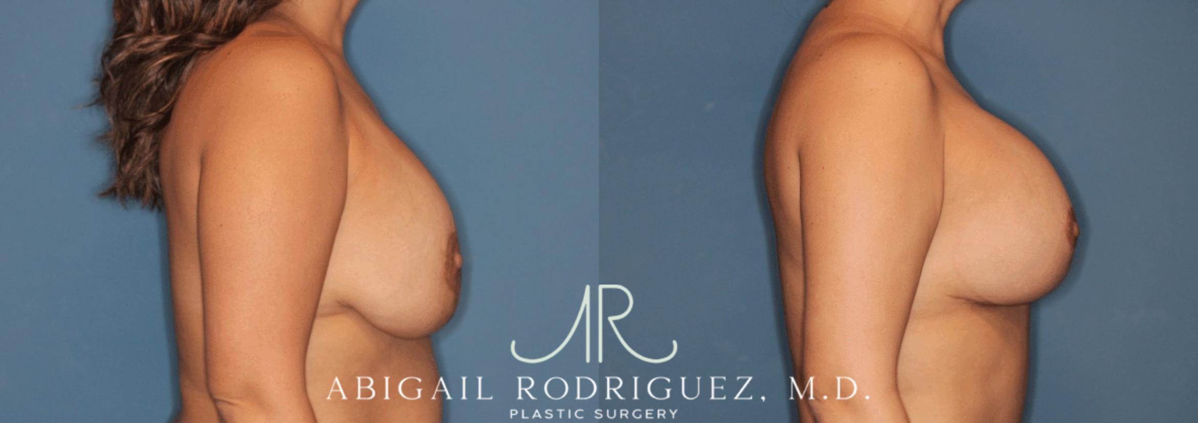 Before & After Breast Revision Case 346000 Right Side View in Houston, TX