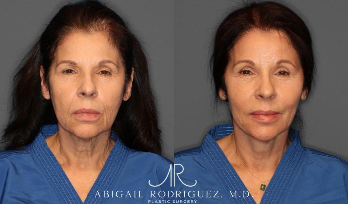 Before & After Brow Lift Case 257434 View 1 View in Houston, TX