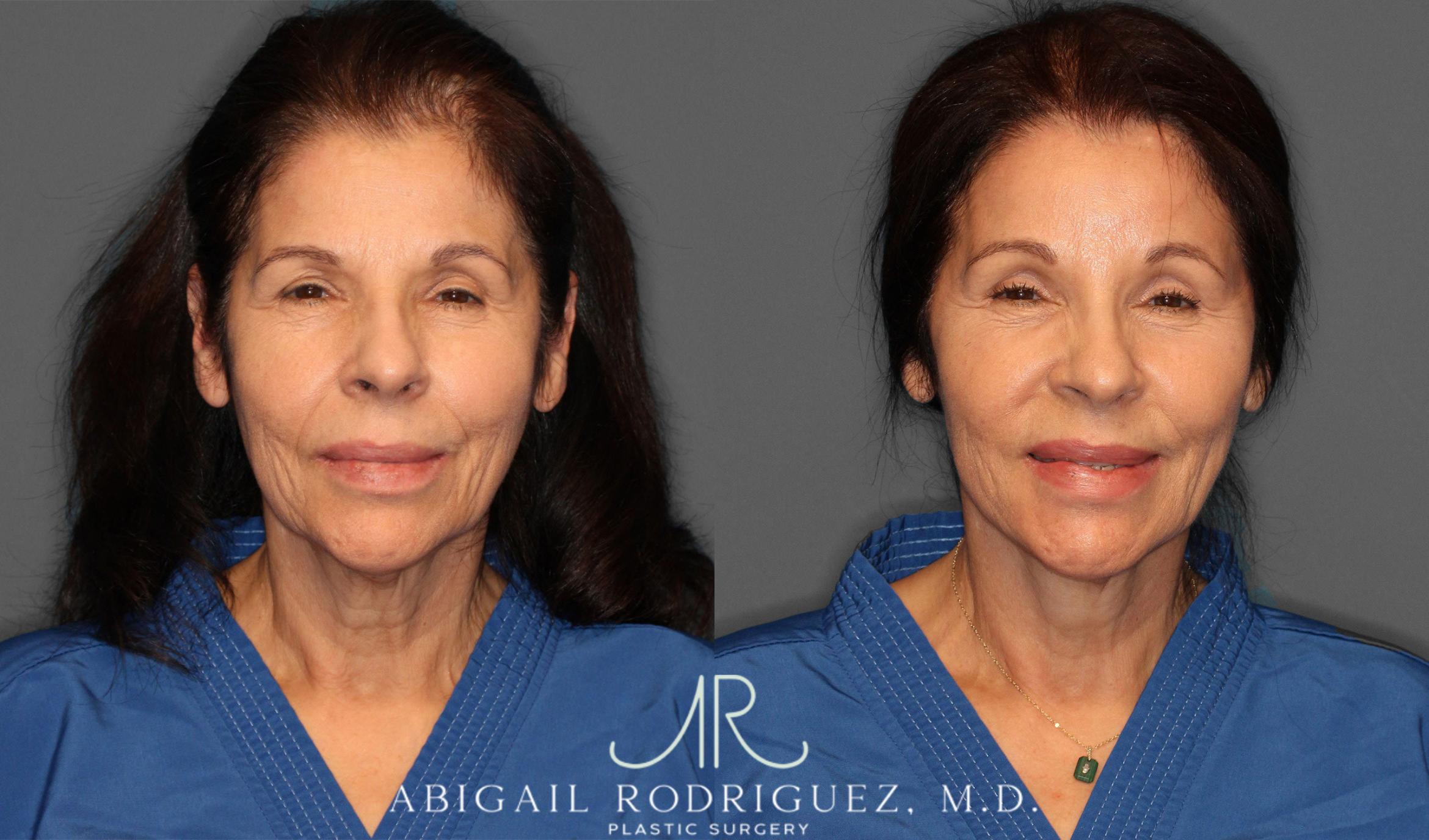 Before & After Brow Lift Case 257434 View 2 View in Houston, TX