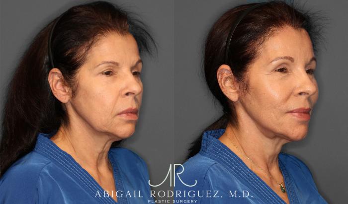 Before & After Brow Lift Case 257434 View 3 View in Houston, TX