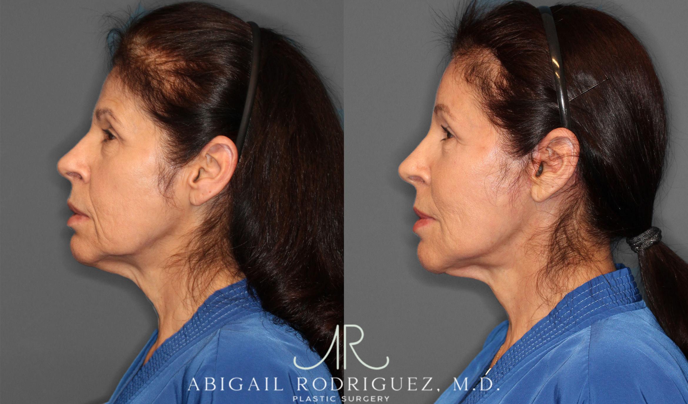 Before & After Brow Lift Case 257434 View 4 View in Houston, TX