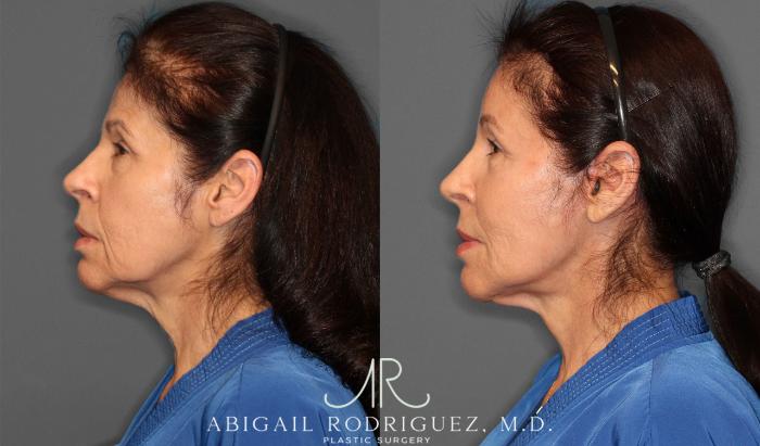 Before & After Brow Lift Case 257434 View 4 View in Houston, TX