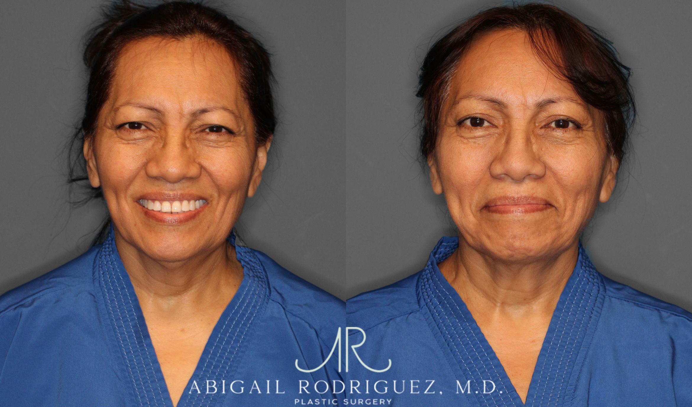 Before & After Brow Lift Case 258295 View 1 View in Houston, TX