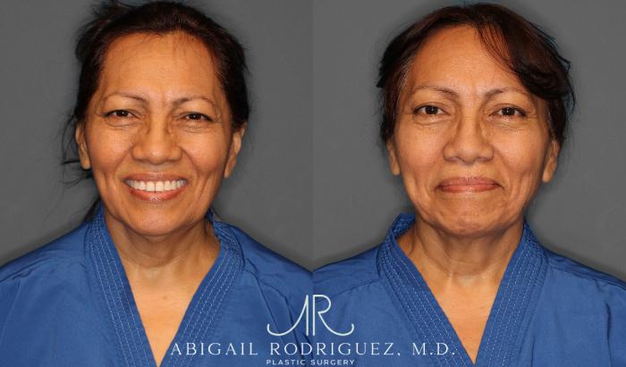 Before & After Brow Lift Case 258295 View 1 View in Houston, TX