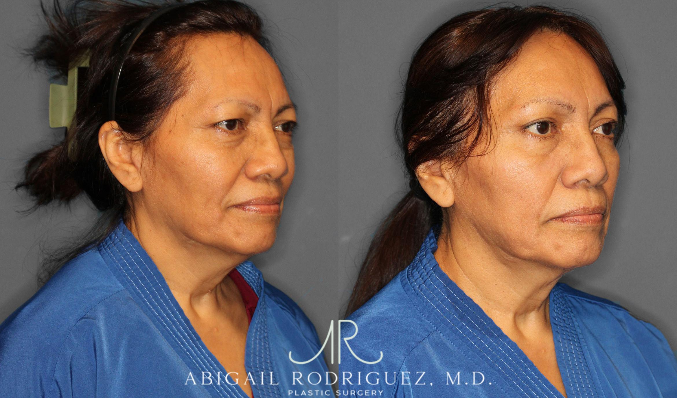 Before & After Brow Lift Case 258295 View 2 View in Houston, TX
