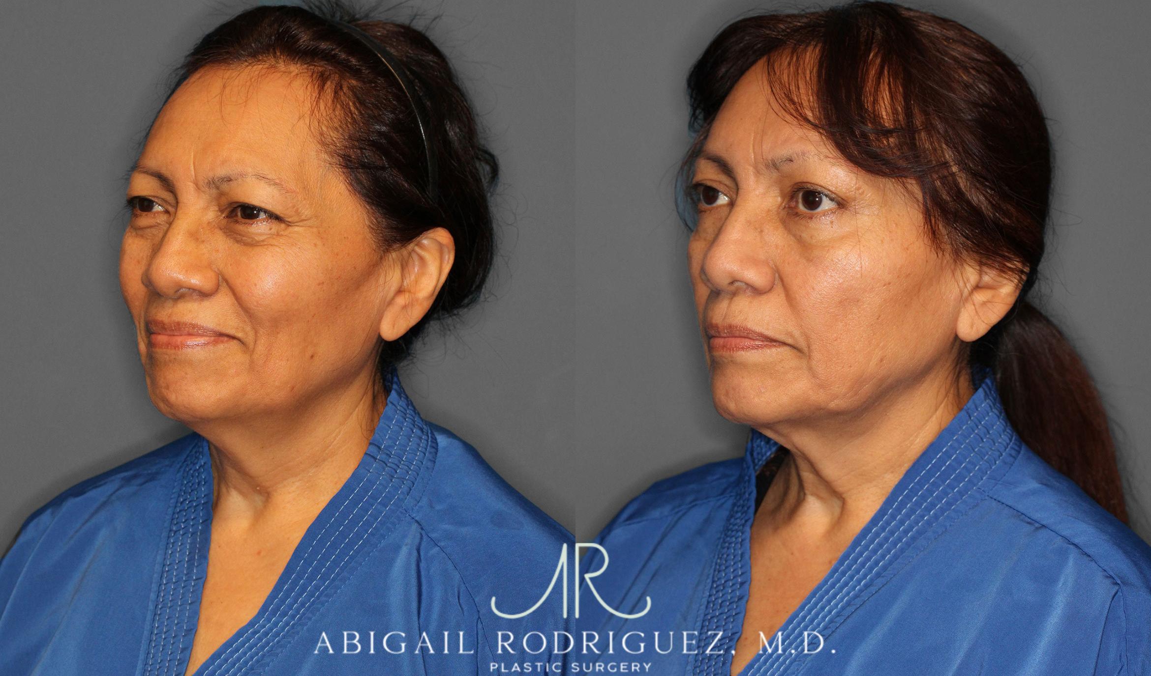 Before & After Brow Lift Case 258295 View 3 View in Houston, TX