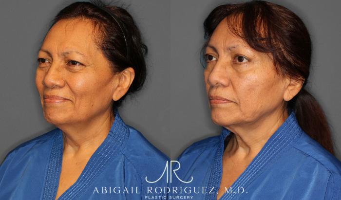 Before & After Brow Lift Case 258295 View 3 View in Houston, TX