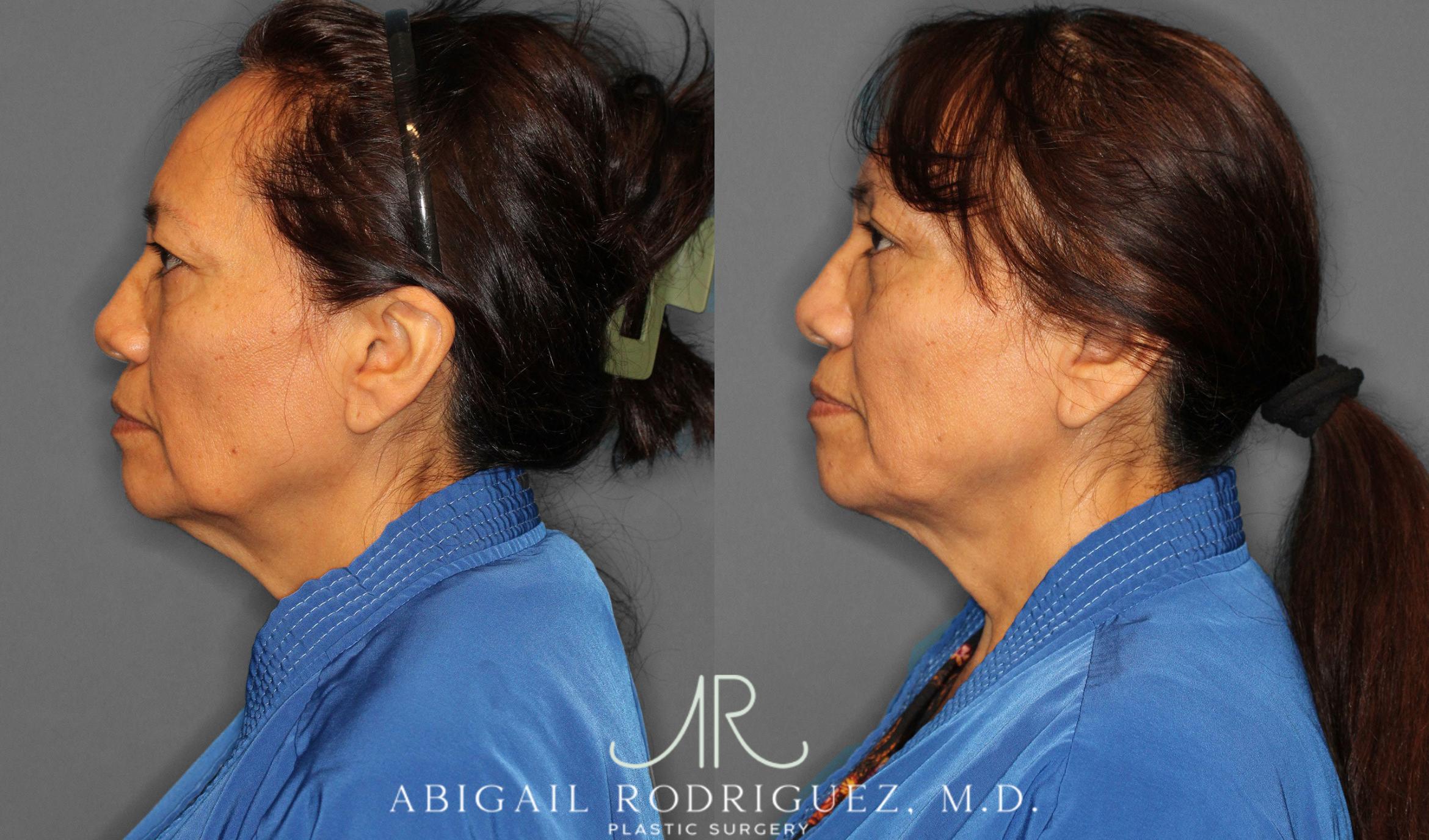 Before & After Brow Lift Case 258295 View 4 View in Houston, TX