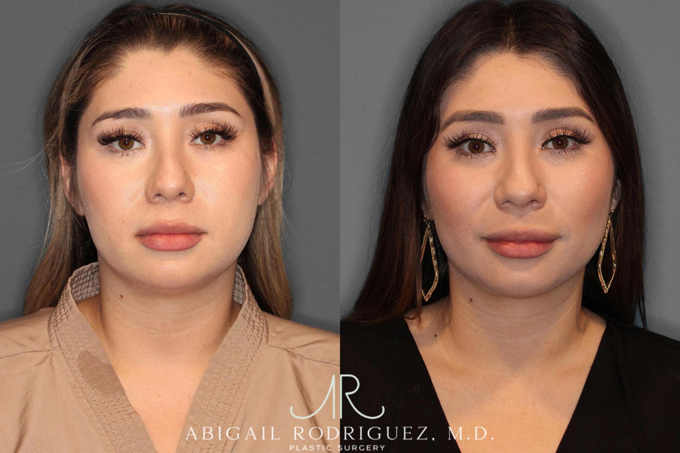 Before & After Buccal Fat Removal Case 254569 View 1 View in Houston, TX