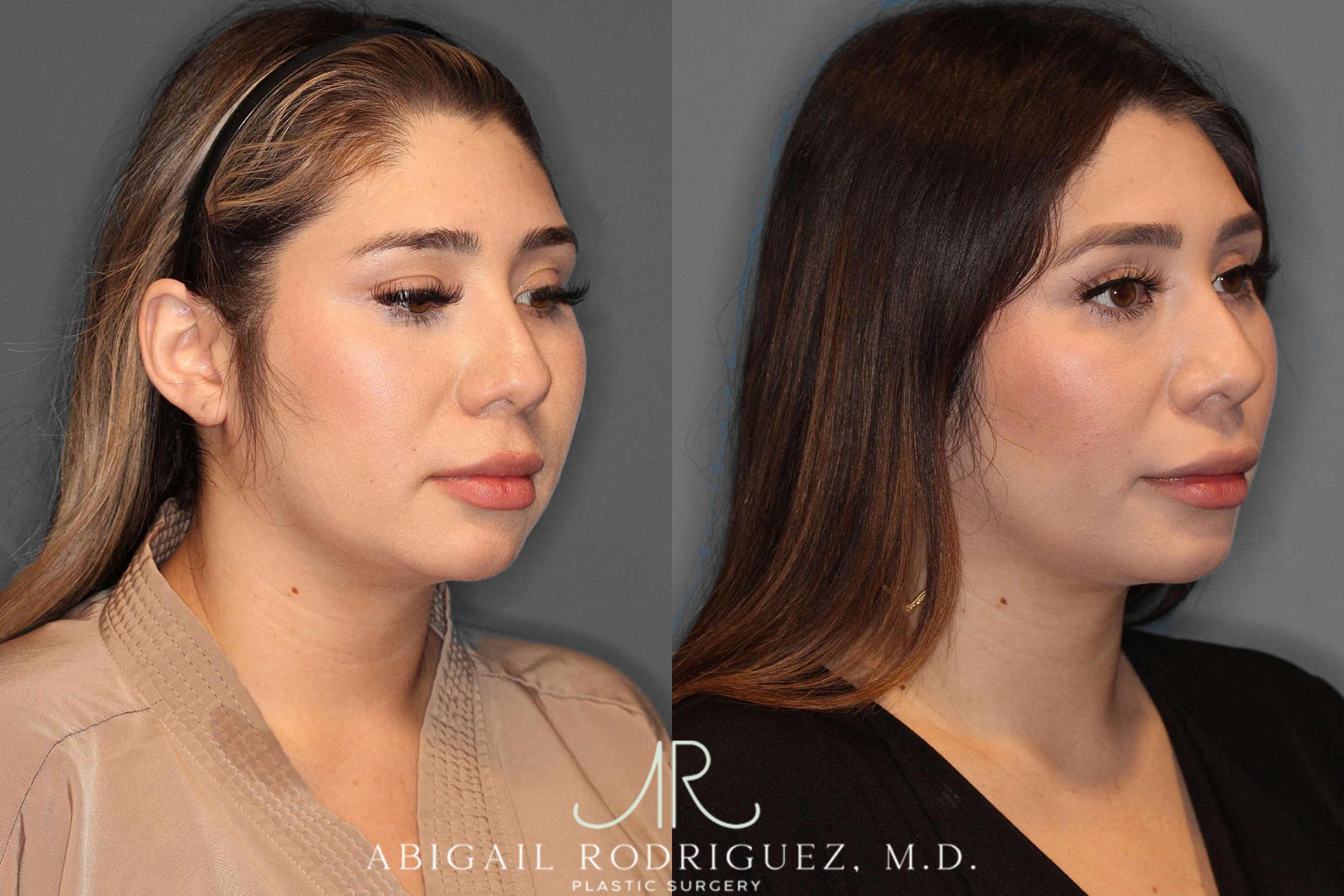 Before & After Buccal Fat Removal Case 254569 View 2 View in Houston, TX