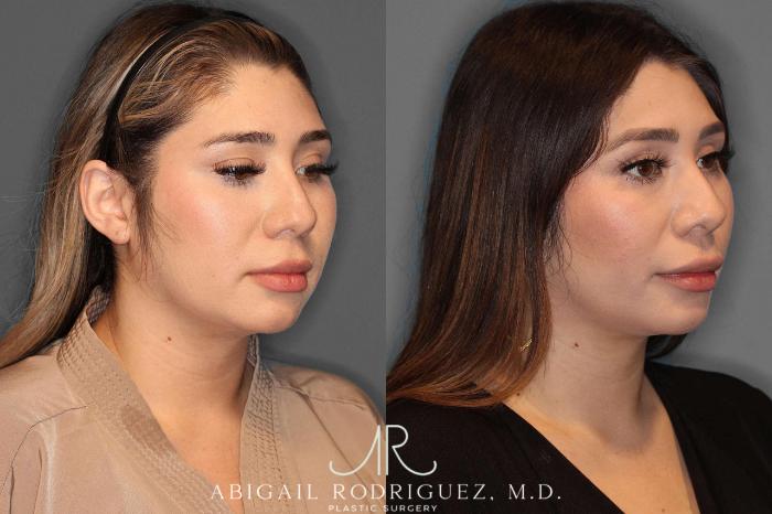 Before & After Buccal Fat Removal Case 254569 View 2 View in Houston, TX