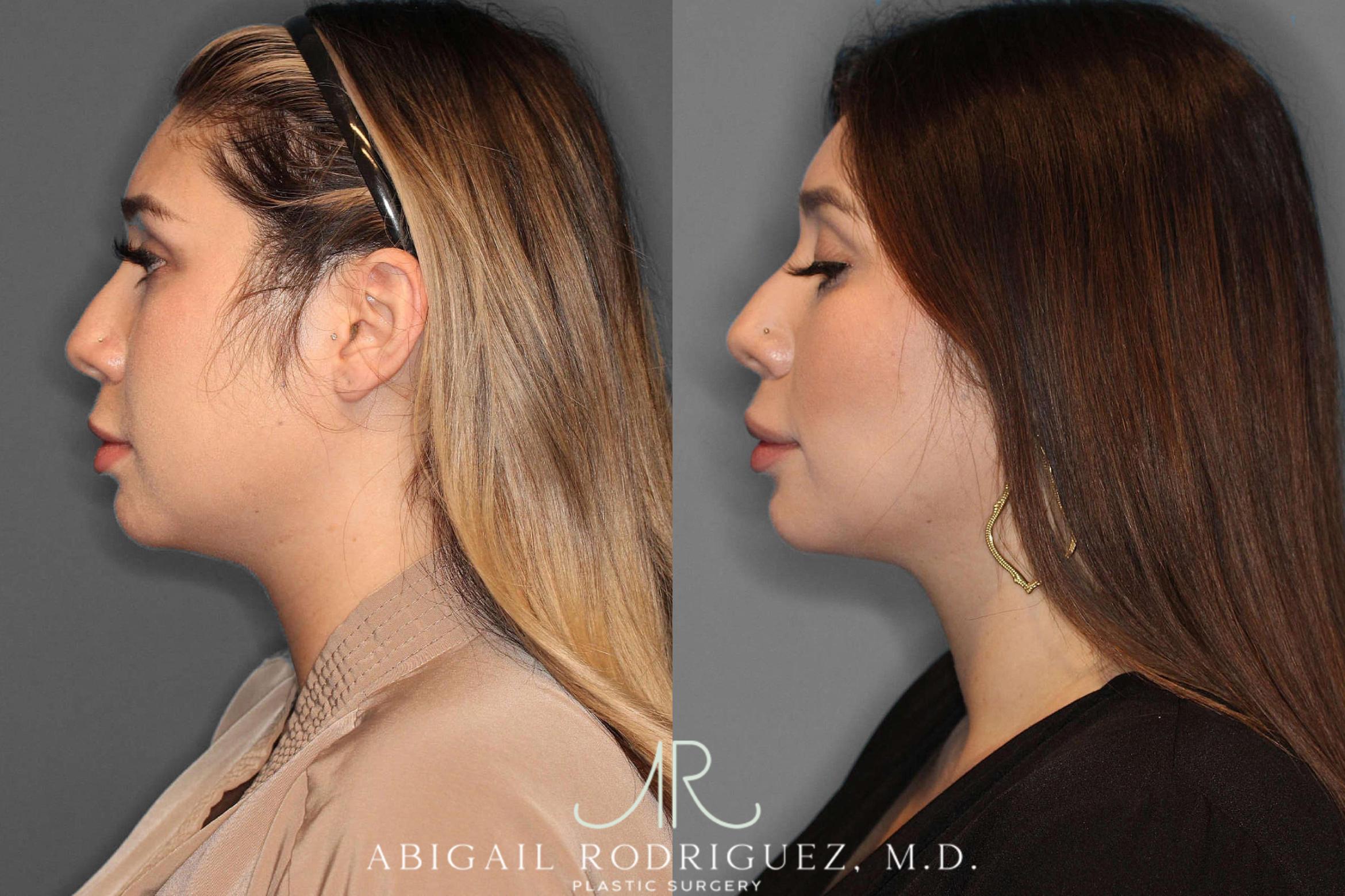 Before & After Buccal Fat Removal Case 254569 View 3 View in Houston, TX