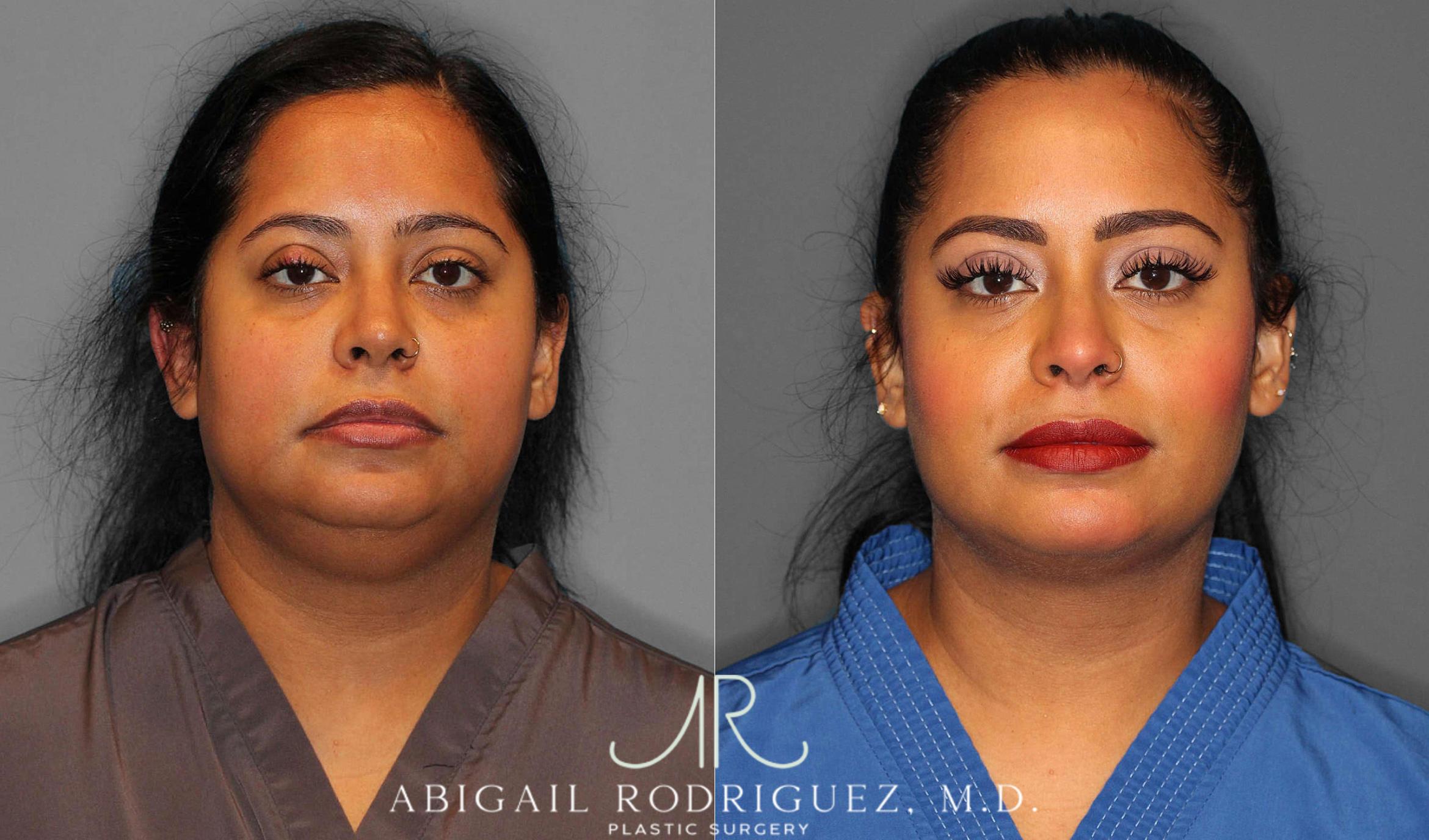 Before & After Buccal Fat Removal Case 254860 View 1 View in Houston, TX