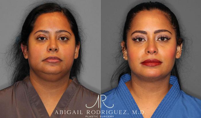 Before & After Neck Liposuction Case 254860 View 1 View in Houston, TX