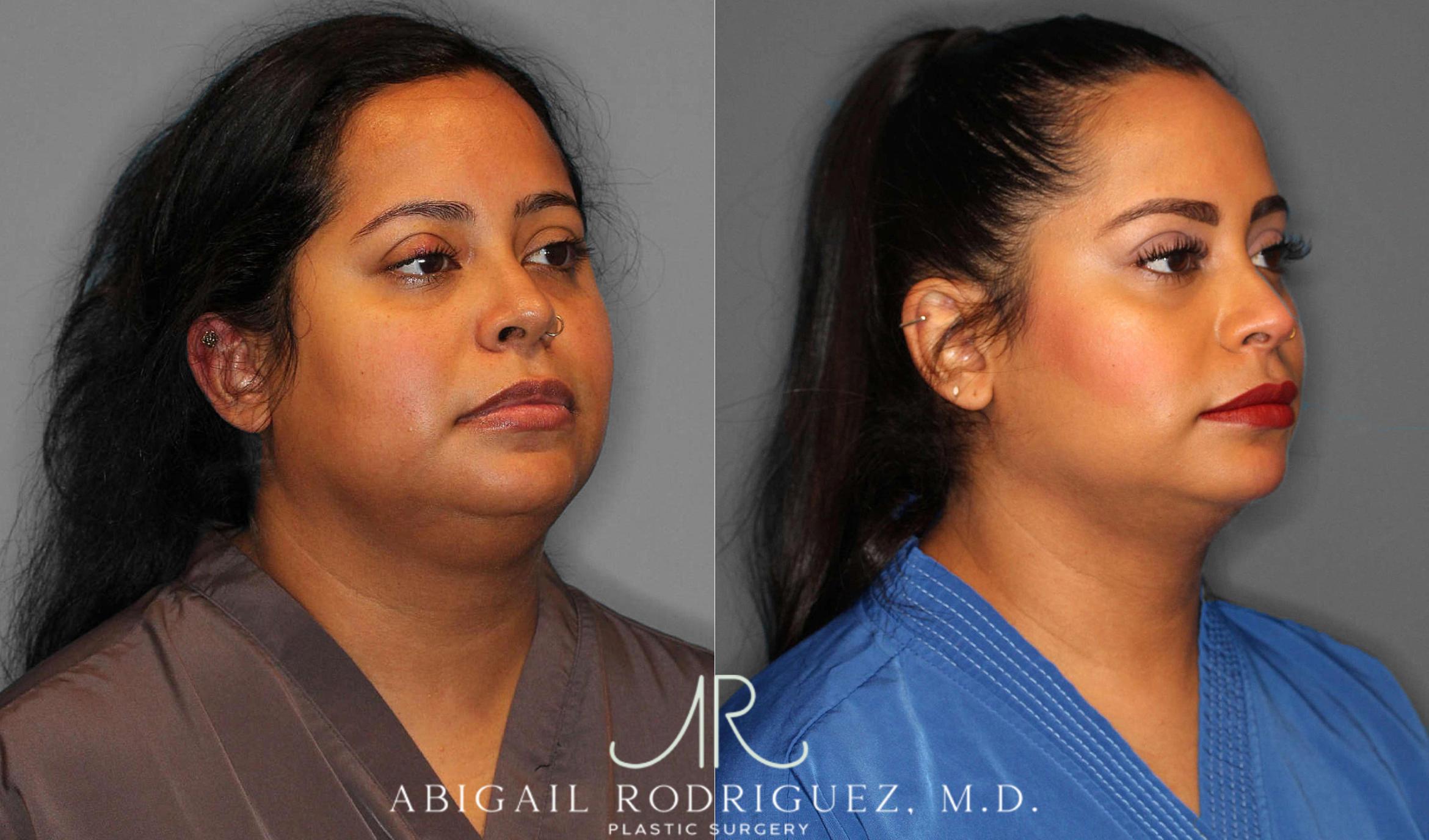 Before & After Buccal Fat Removal Case 254860 View 2 View in Houston, TX