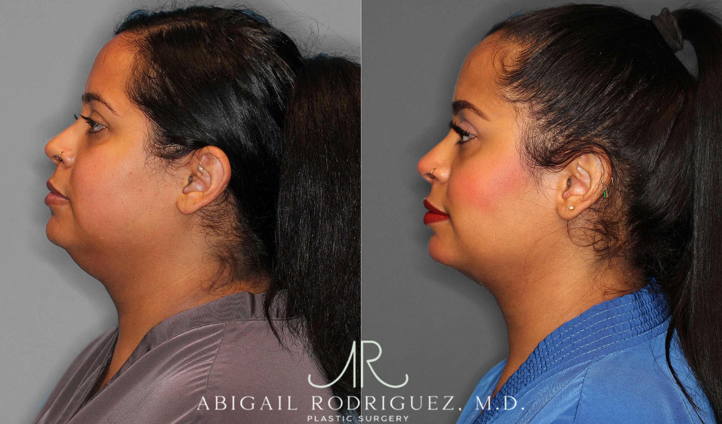 Before & After Buccal Fat Removal Case 254860 View 3 View in Houston, TX
