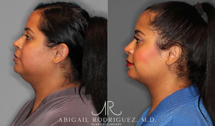 Before & After Buccal Fat Removal Case 254860 View 3 View in Houston, TX