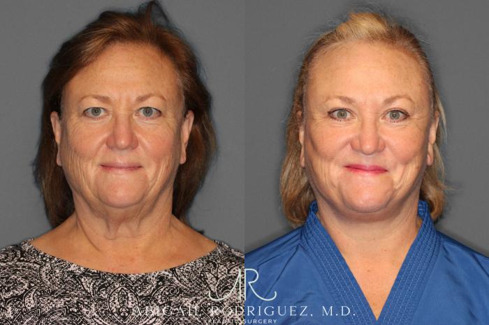 Before & After Neck Lift Case 149212 View 1 View in Houston, TX