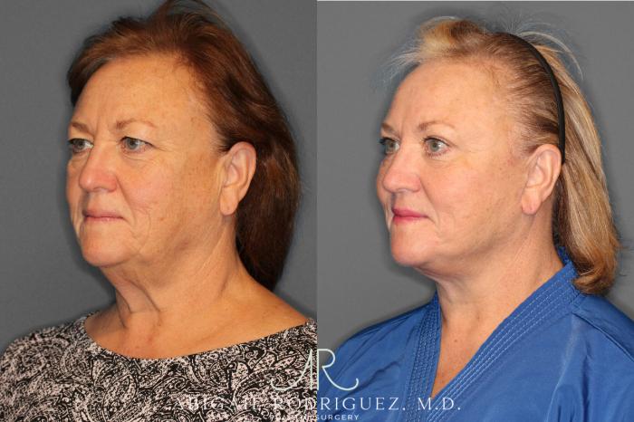 Before & After Facelift Case 149212 View 2 View in Houston, TX