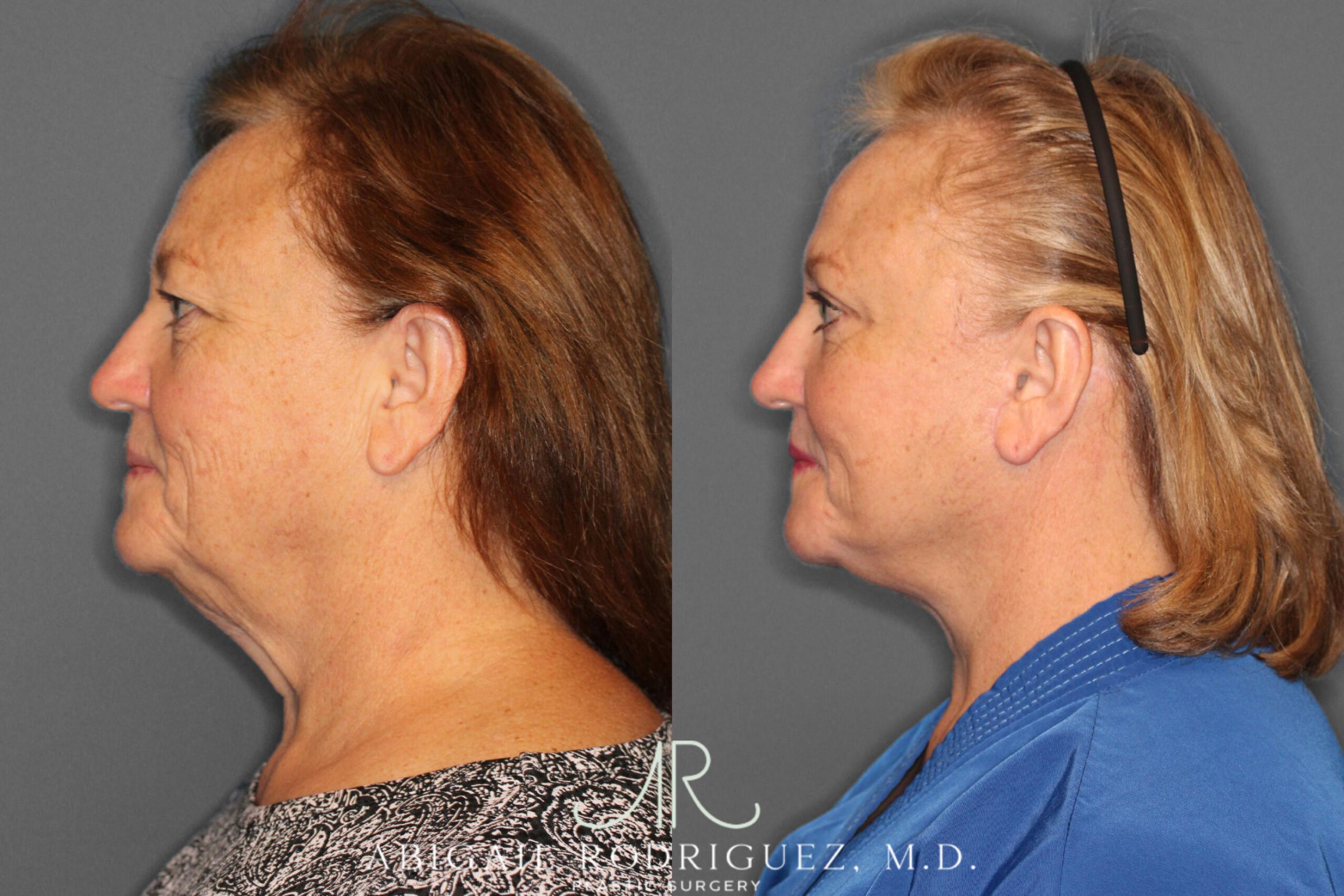 Before & After Facelift Case 149212 View 3 View in Houston, TX