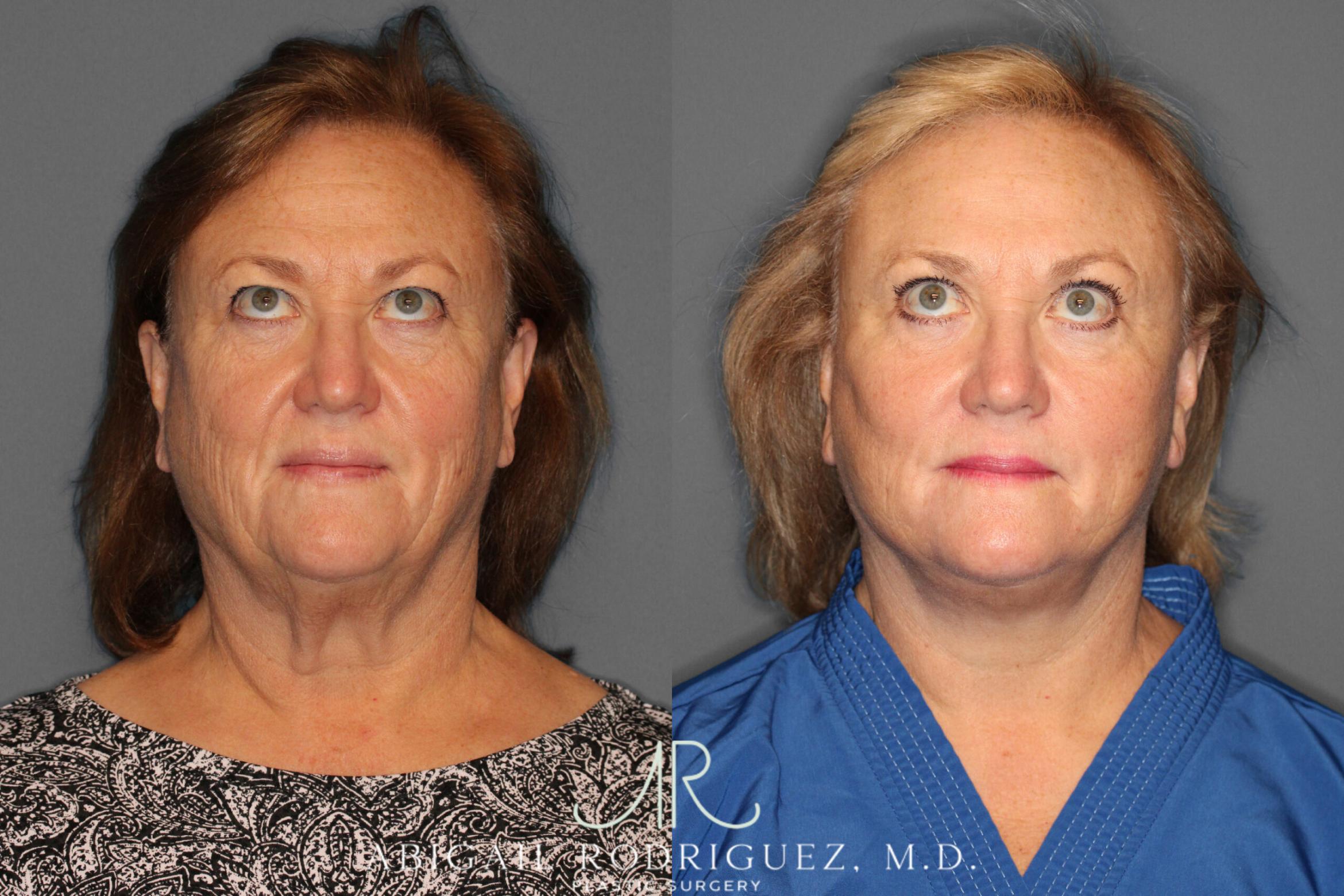 Before & After Facelift Case 149212 View 4 View in Houston, TX