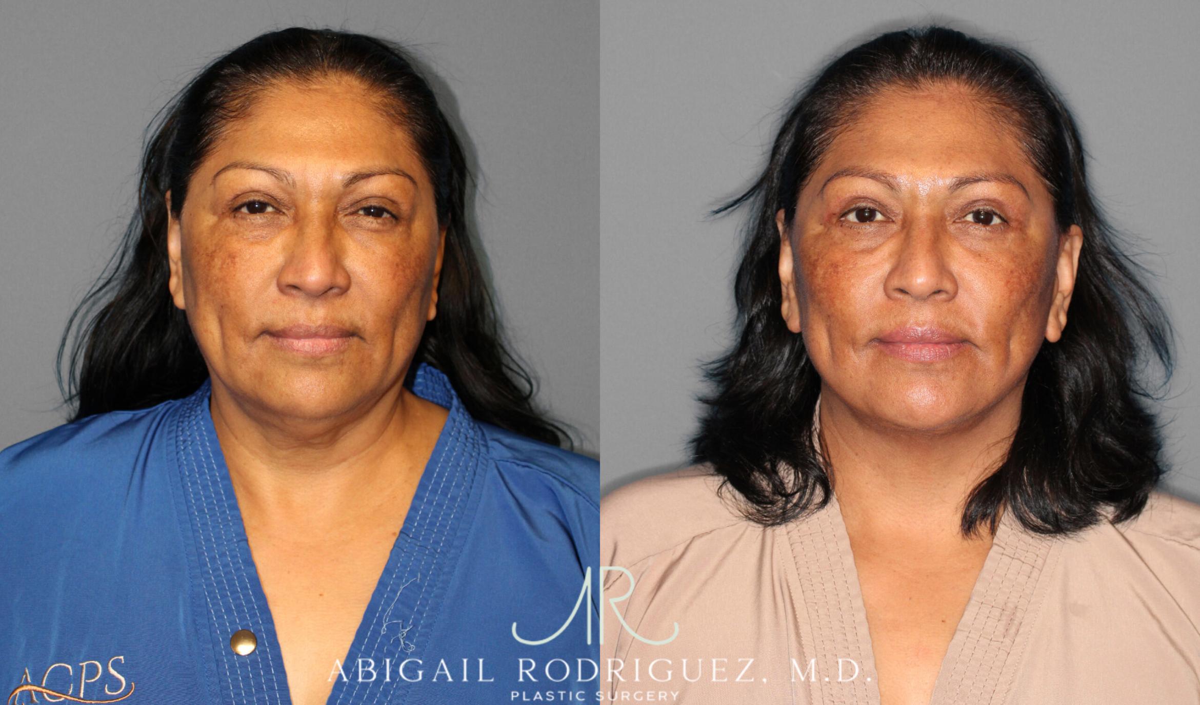 Before & After Facelift Case 254034 View 1 View in Houston, TX