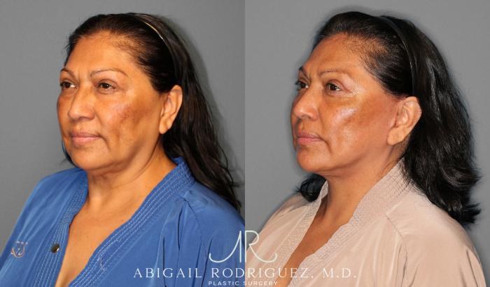 Before & After Facelift Case 254034 View 2 View in Houston, TX