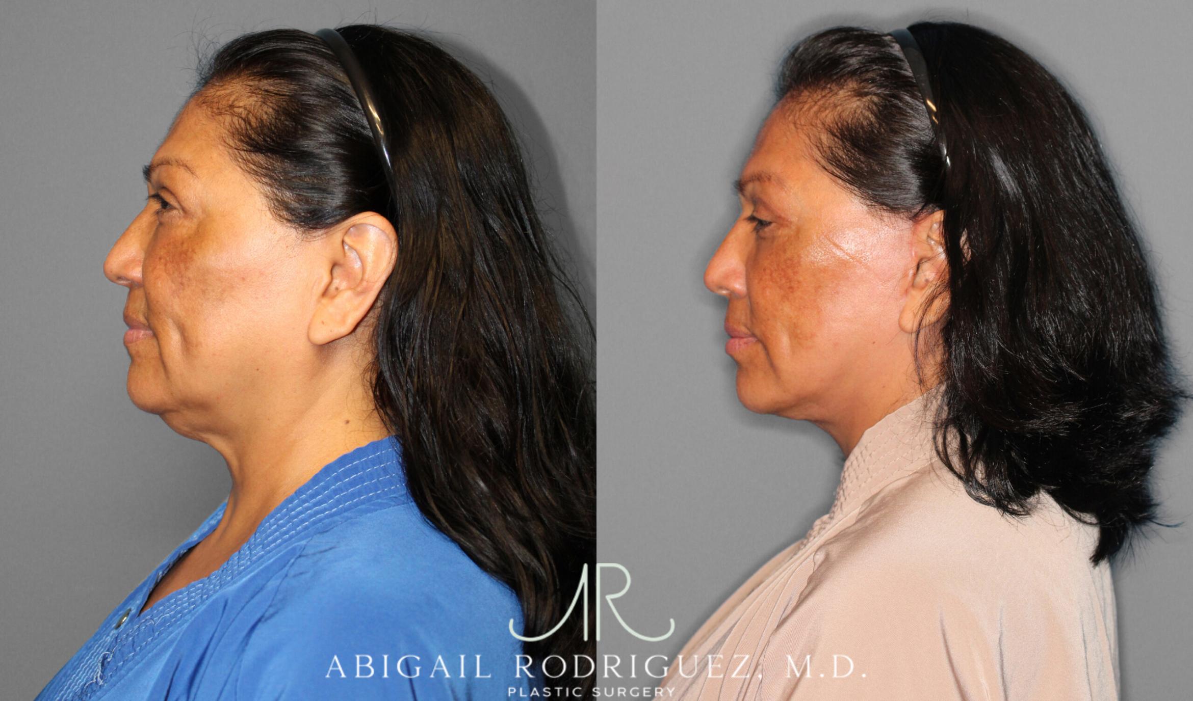 Before & After Facelift Case 254034 View 3 View in Houston, TX