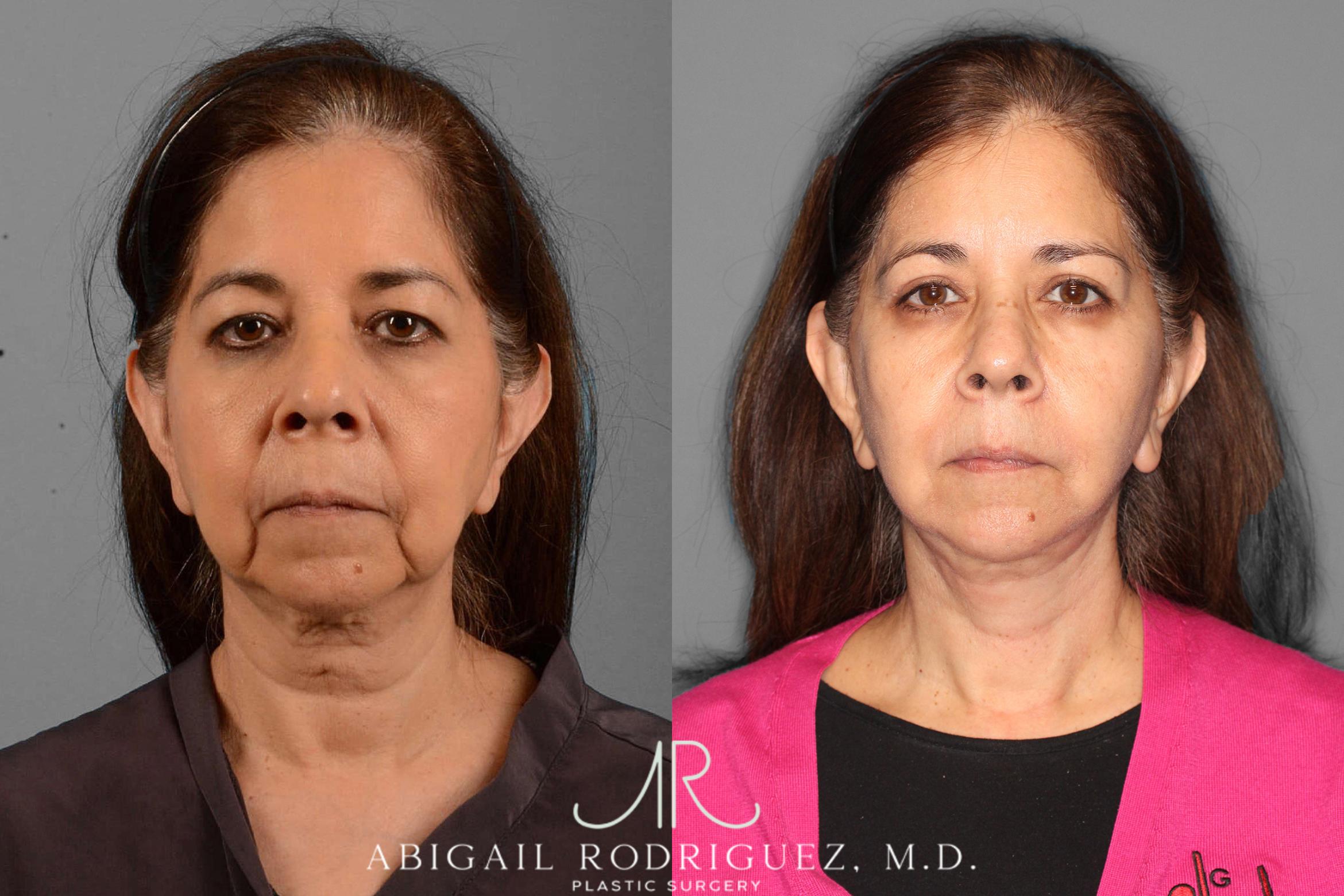 Before & After Facelift Case 254189 View 1 View in Houston, TX