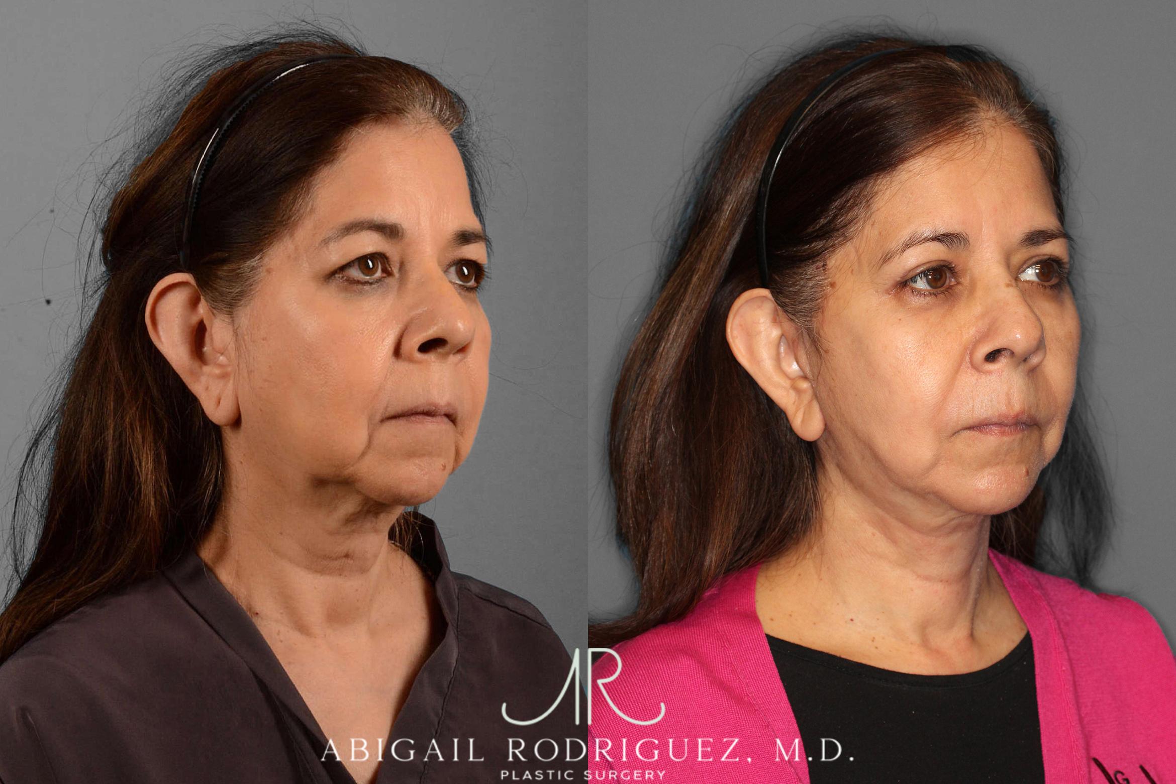 Before & After Facelift Case 254189 View 2 View in Houston, TX