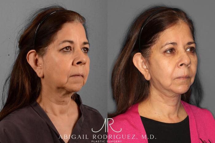 Before & After Facelift Case 254189 View 2 View in Houston, TX