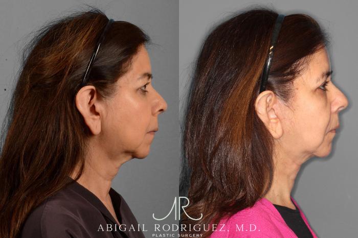 Before & After Facelift Case 254189 View 3 View in Houston, TX