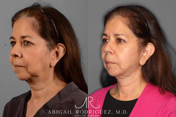 Before & After Facelift Case 254189 View 4 View in Houston, TX