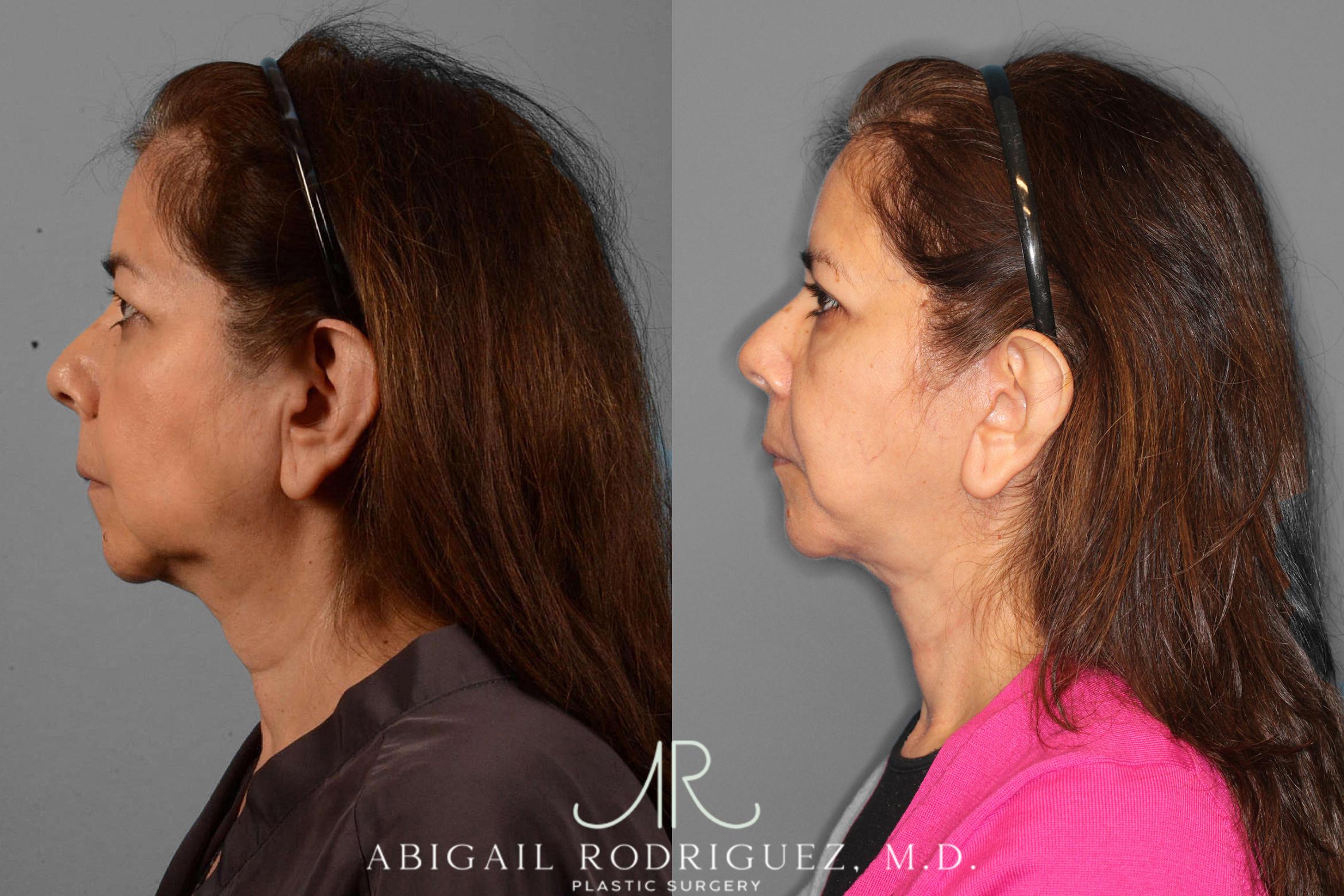 Before & After Facelift Case 254189 View 5 View in Houston, TX