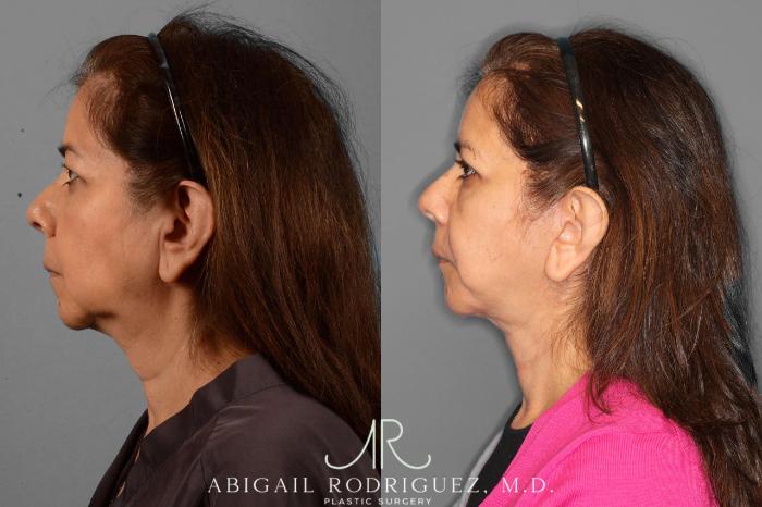 Before & After Facelift Case 254189 View 5 View in Houston, TX