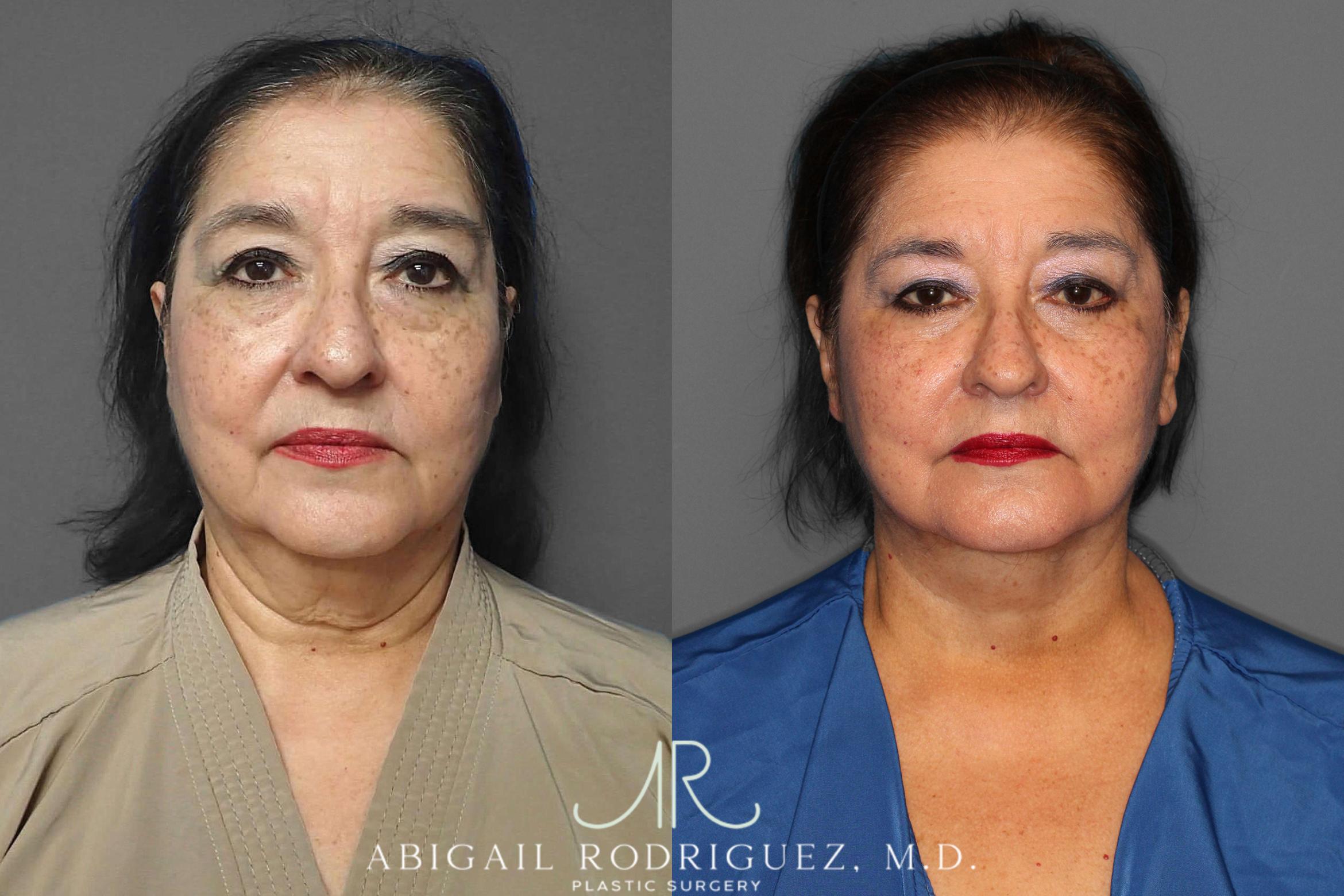 Before & After Facelift Case 254190 View 1 View in Houston, TX
