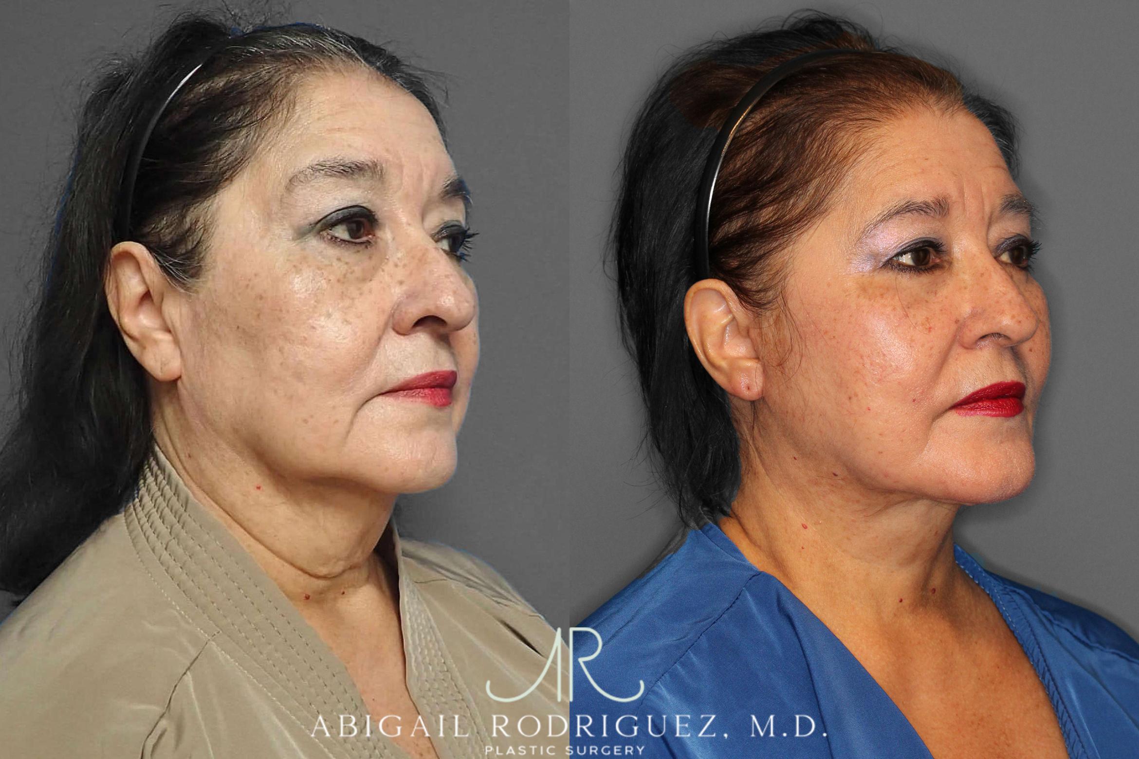 Before & After Facelift Case 254190 View 2 View in Houston, TX