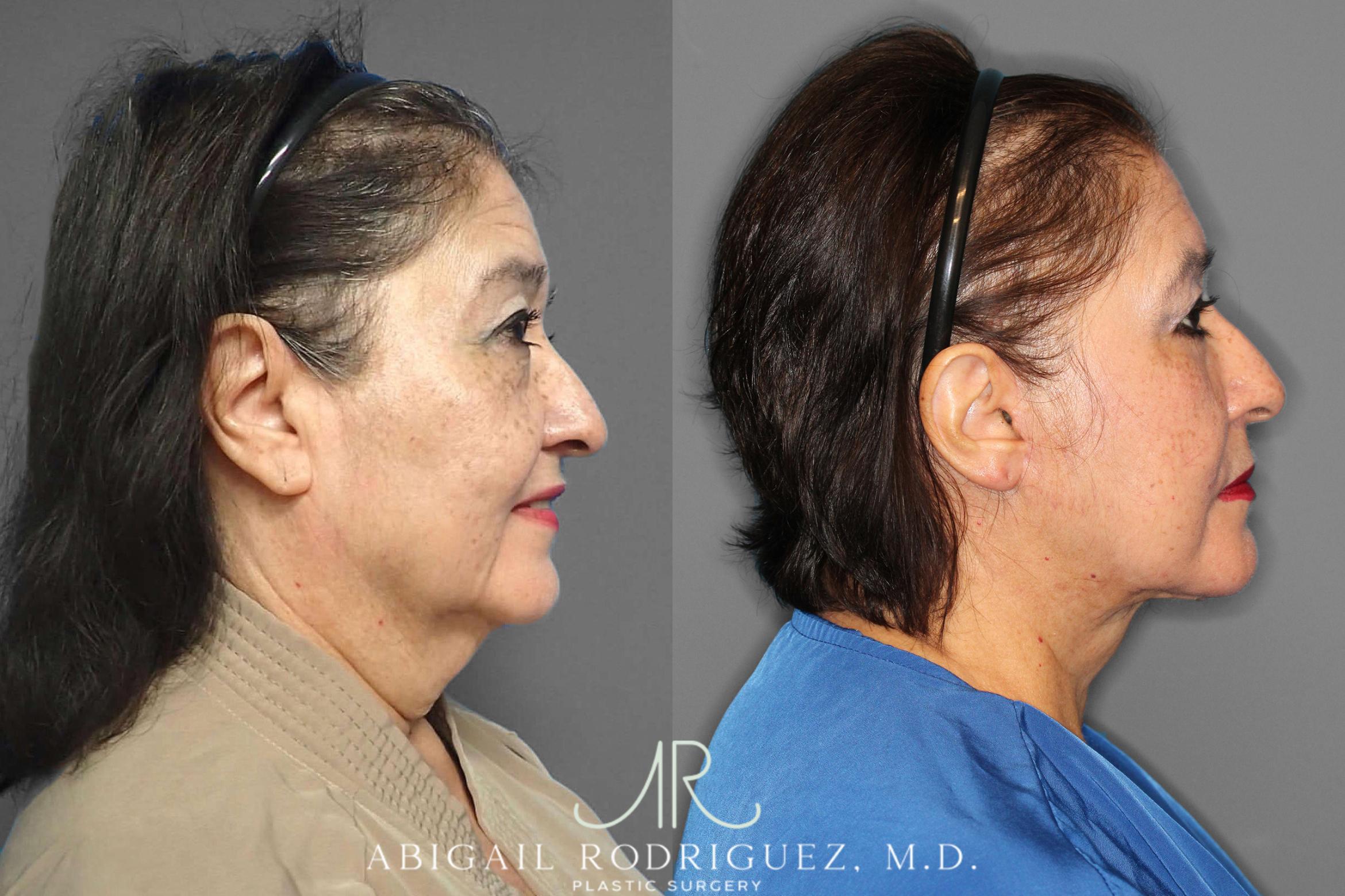Before & After Facelift Case 254190 View 3 View in Houston, TX