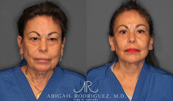 Before & After Facelift Case 258228 View 1 View in Houston, TX