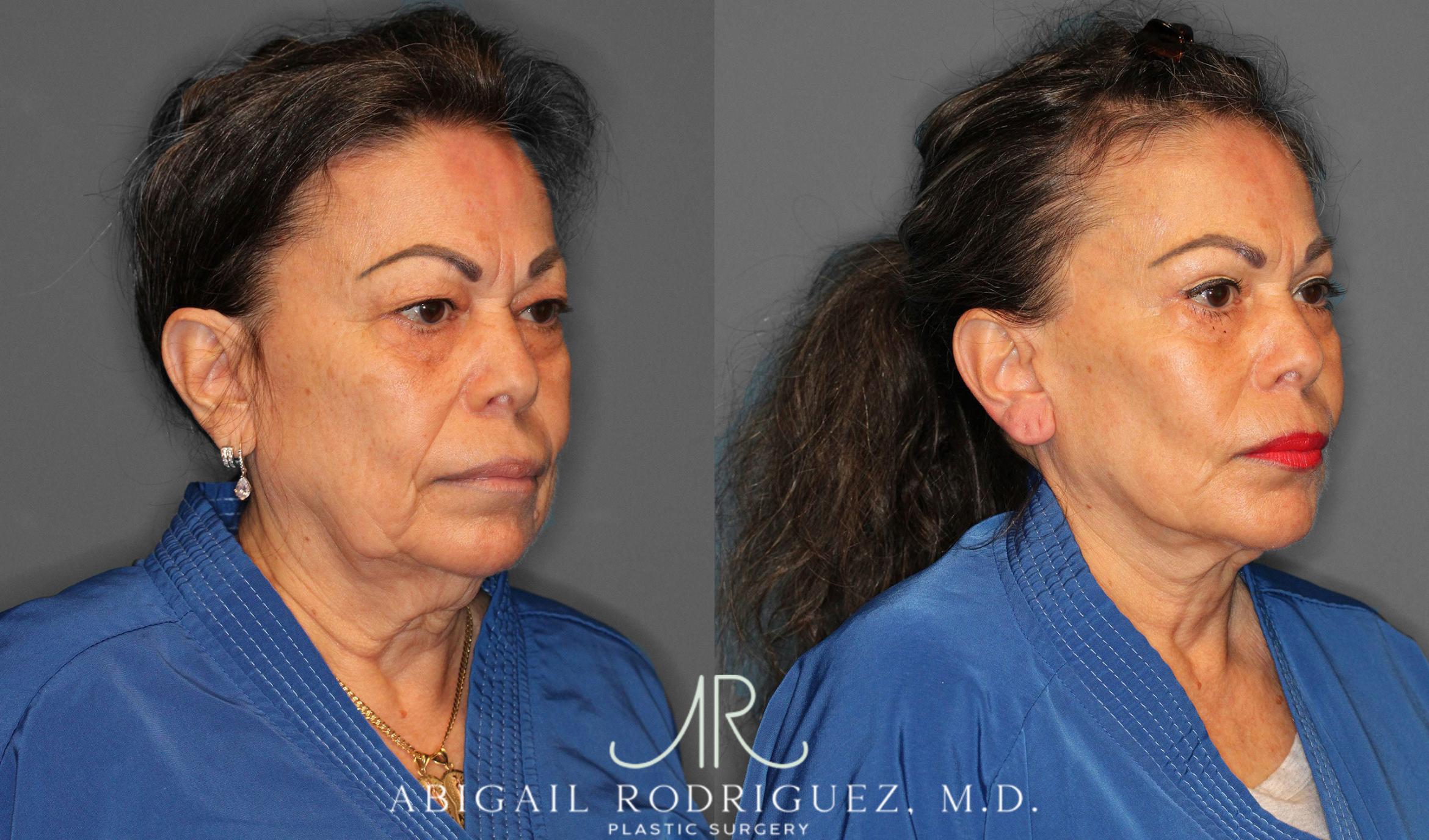 Before & After Facelift Case 258228 View 2 View in Houston, TX