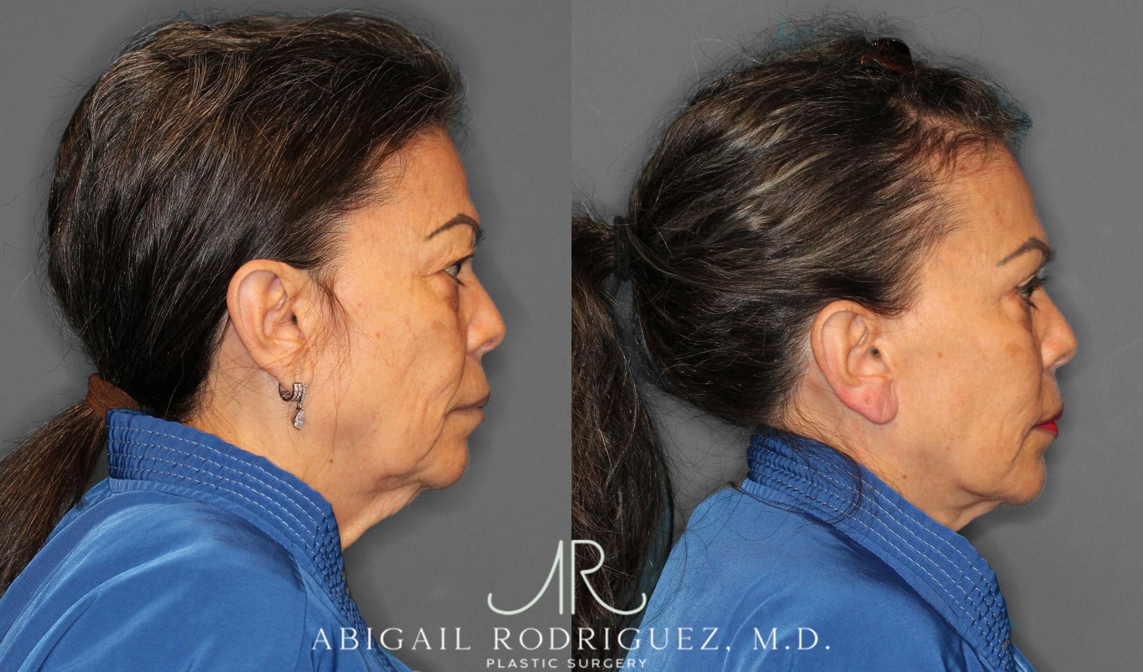 Before & After Facelift Case 258228 View 3 View in Houston, TX