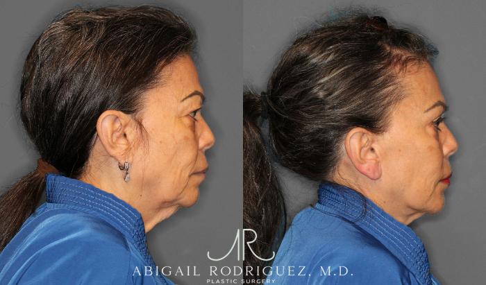 Before & After Facelift Case 258228 View 3 View in Houston, TX