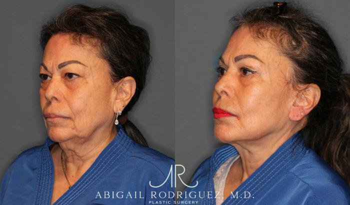 Before & After Facelift Case 258228 View 4 View in Houston, TX
