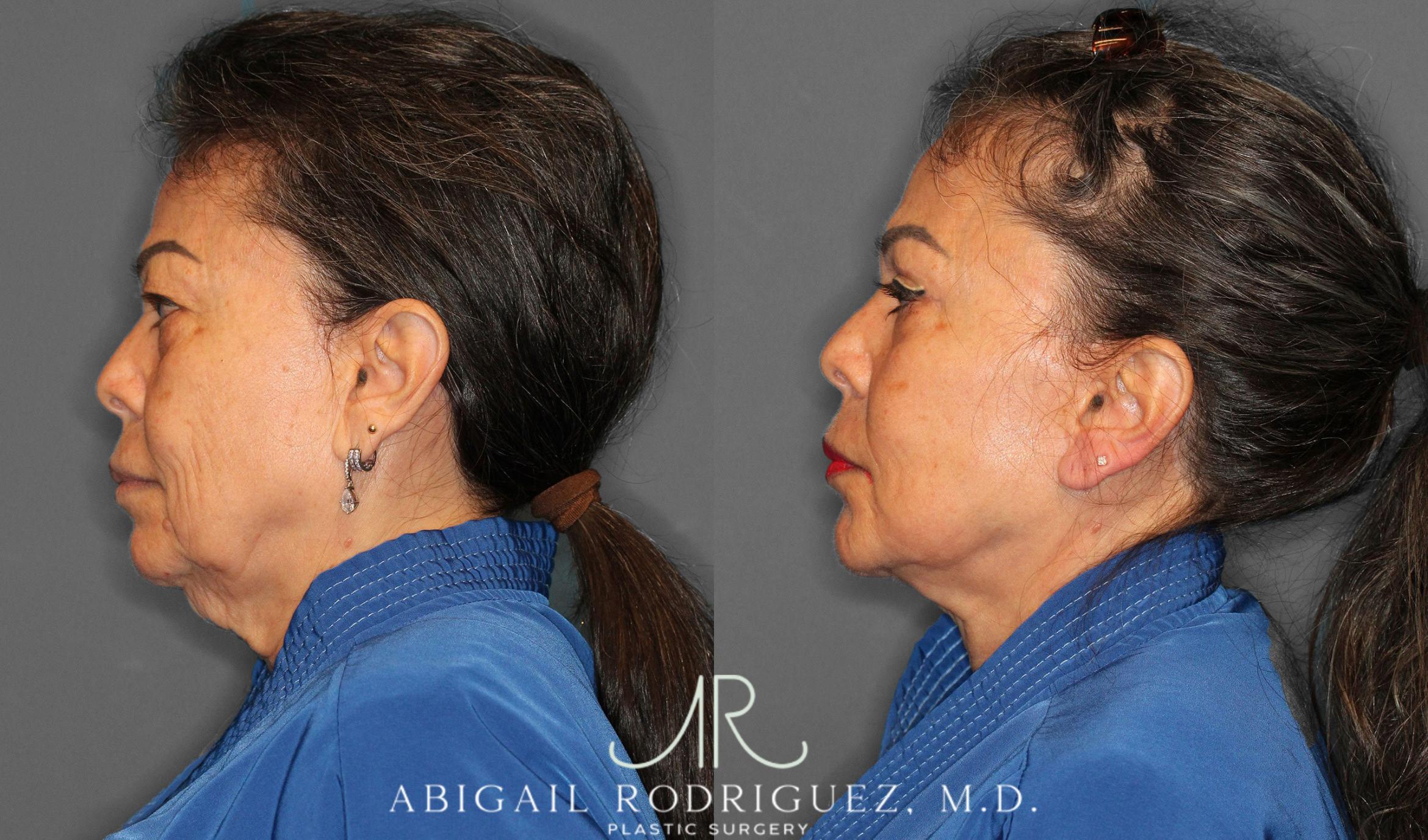 Before & After Facelift Case 258228 View 5 View in Houston, TX