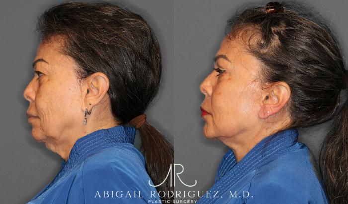 Before & After Facelift Case 258228 View 5 View in Houston, TX