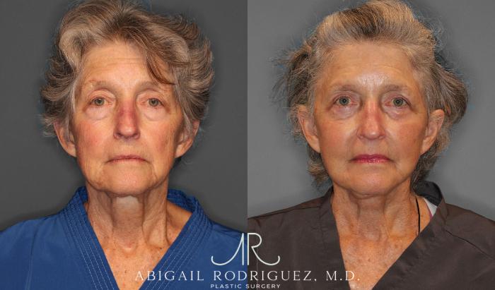 Before & After Facelift Case 258236 View 1 View in Houston, TX