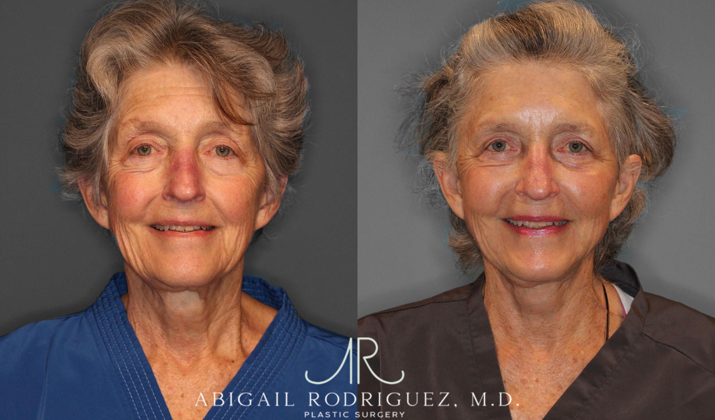 Before & After Facelift Case 258236 View 2 View in Houston, TX