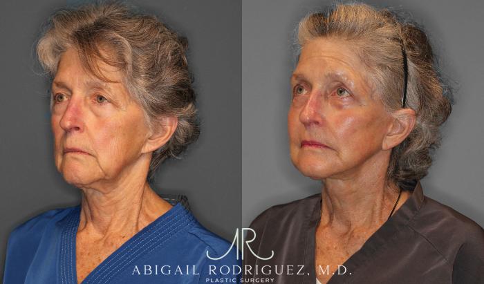 Before & After Facelift Case 258236 View 3 View in Houston, TX