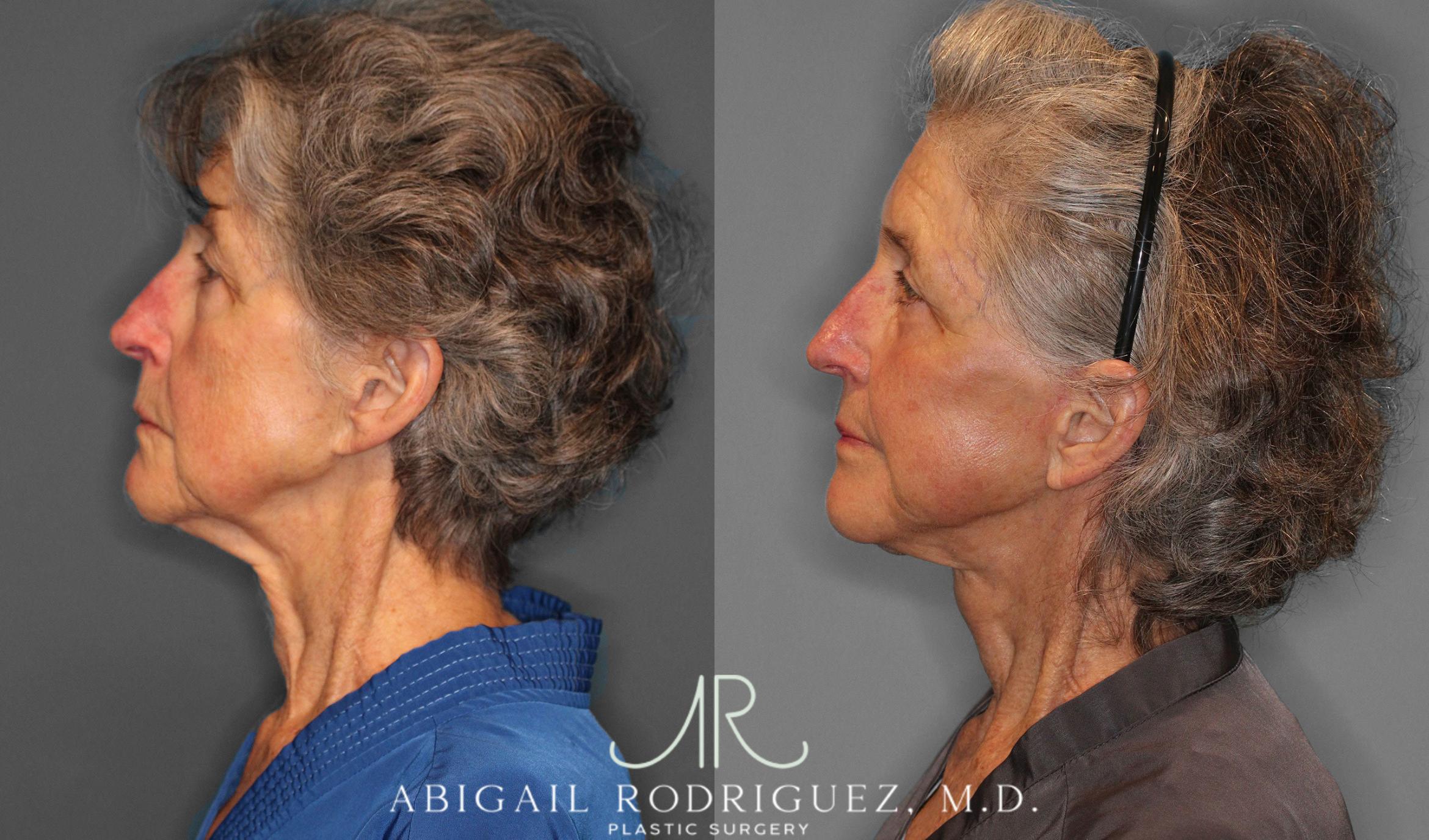Before & After Facelift Case 258236 View 4 View in Houston, TX